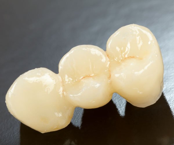 eMax Crowns