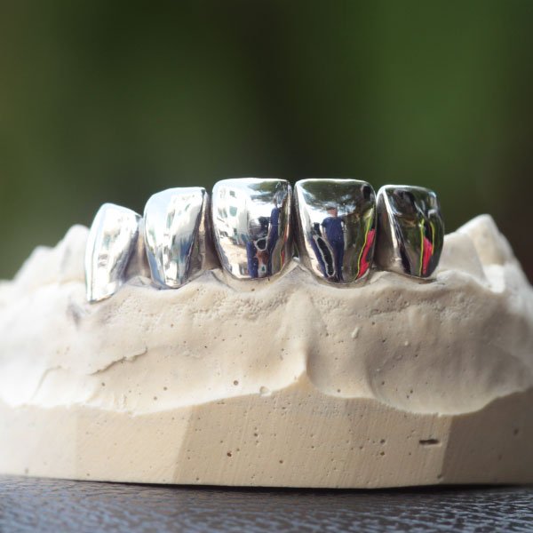 Non-Precious Crown or Onlay